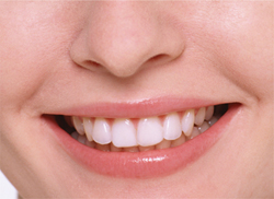 ホワイトニング 治療後