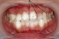 ホワイトニング 治療後2
