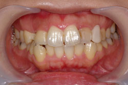 ホワイトニング 治療前2